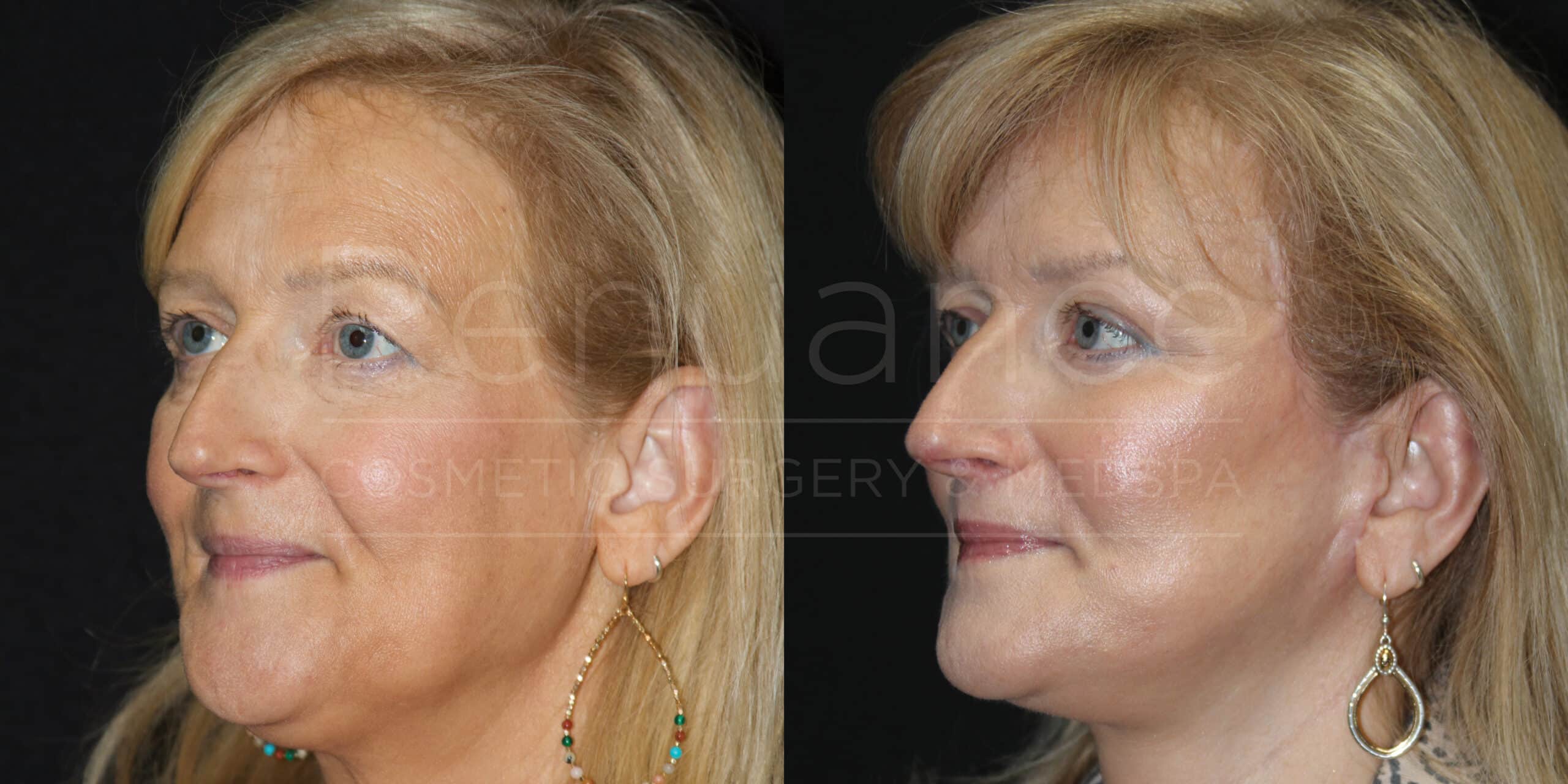 Side-by-side images of the same woman before and after cosmetic surgery. The left image shows the woman with more pronounced facial lines and sagging skin, while the right image shows her with smoother skin and tightened facial features. She is wearing large hoop earrings with colorful beads in both images.
