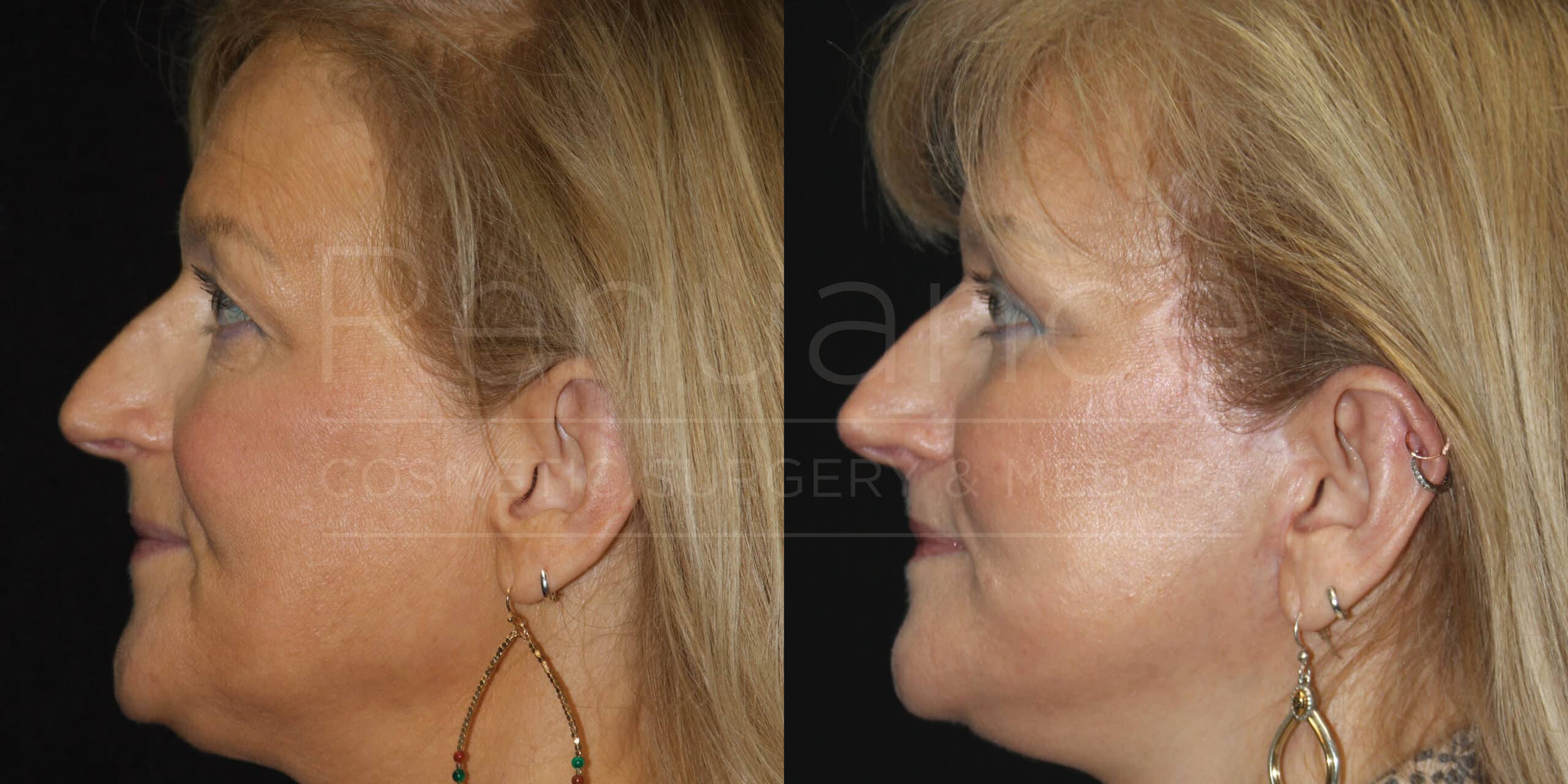 Side-by-side comparison of a woman before and after a cosmetic procedure. The image on the left shows the woman before the procedure, and the image on the right shows the woman after the procedure. Both images are taken from the side, highlighting changes to her facial profile. She has blonde hair and is wearing earrings in both images.