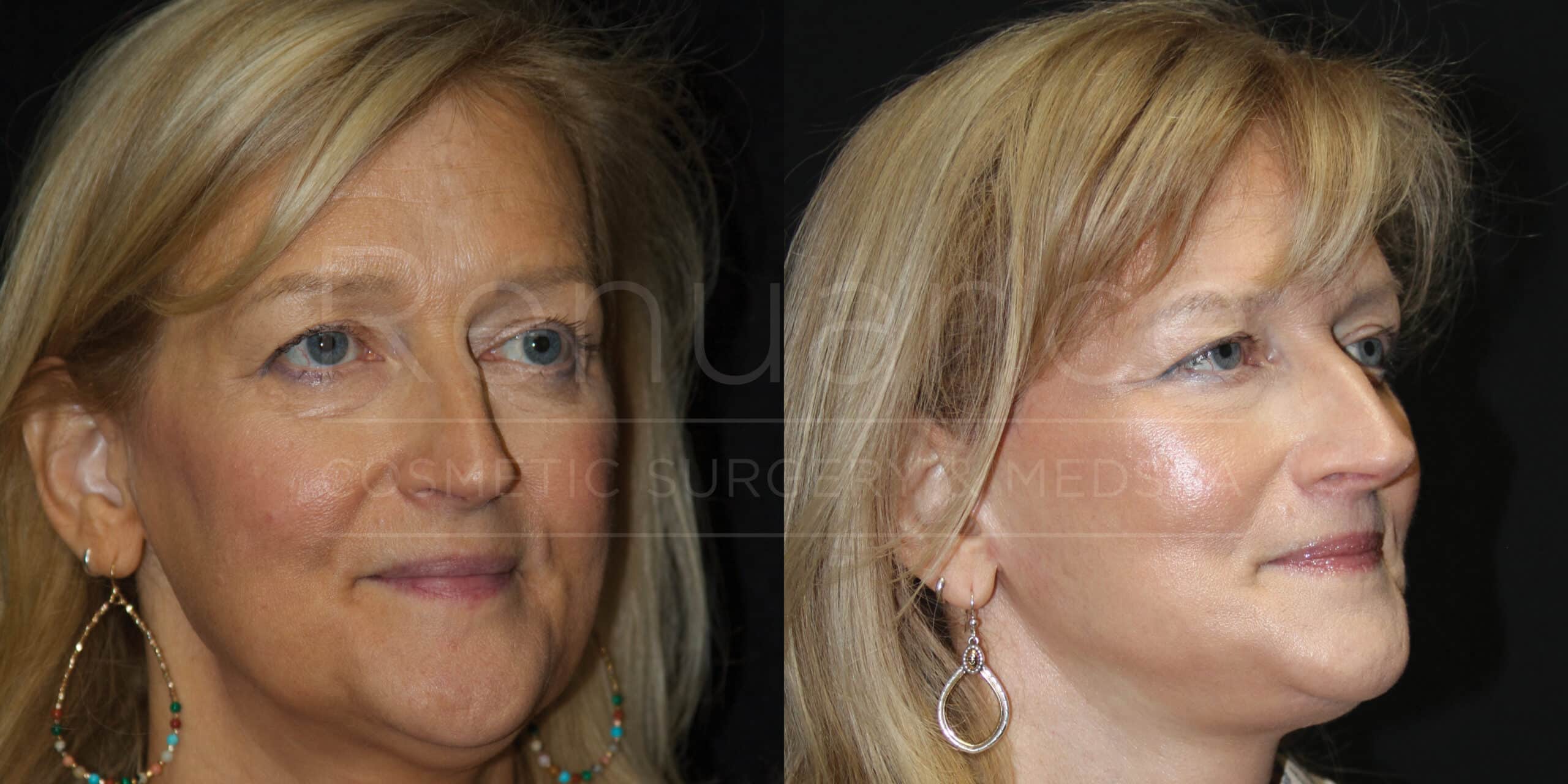 Side-by-side comparison of a woman showing before and after results. The image on the left shows her face from the front, and on the right, she is angled to the side. She has blonde hair and is wearing earrings. The after photo shows smoother skin and a more defined jawline.