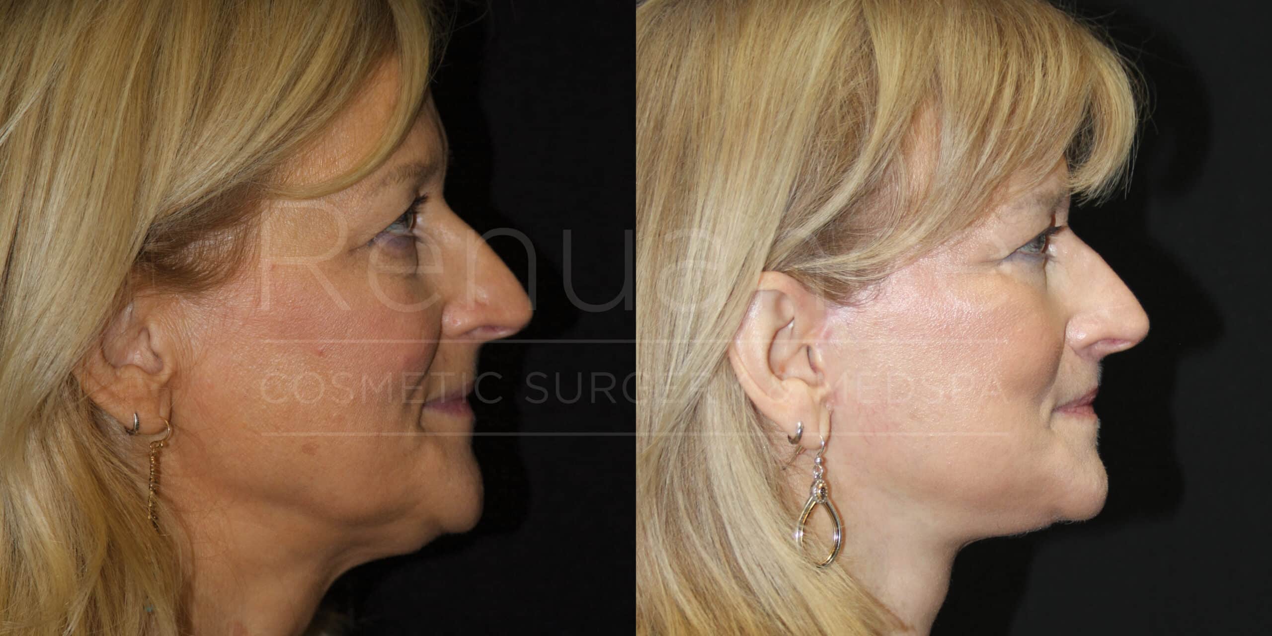 Side-by-side comparison of a woman's profile before and after a cosmetic procedure. The left image shows her with a double chin and less defined jawline, while the right image shows a more contoured jawline and reduced chin. She has blonde hair and is wearing the same earrings in both images.