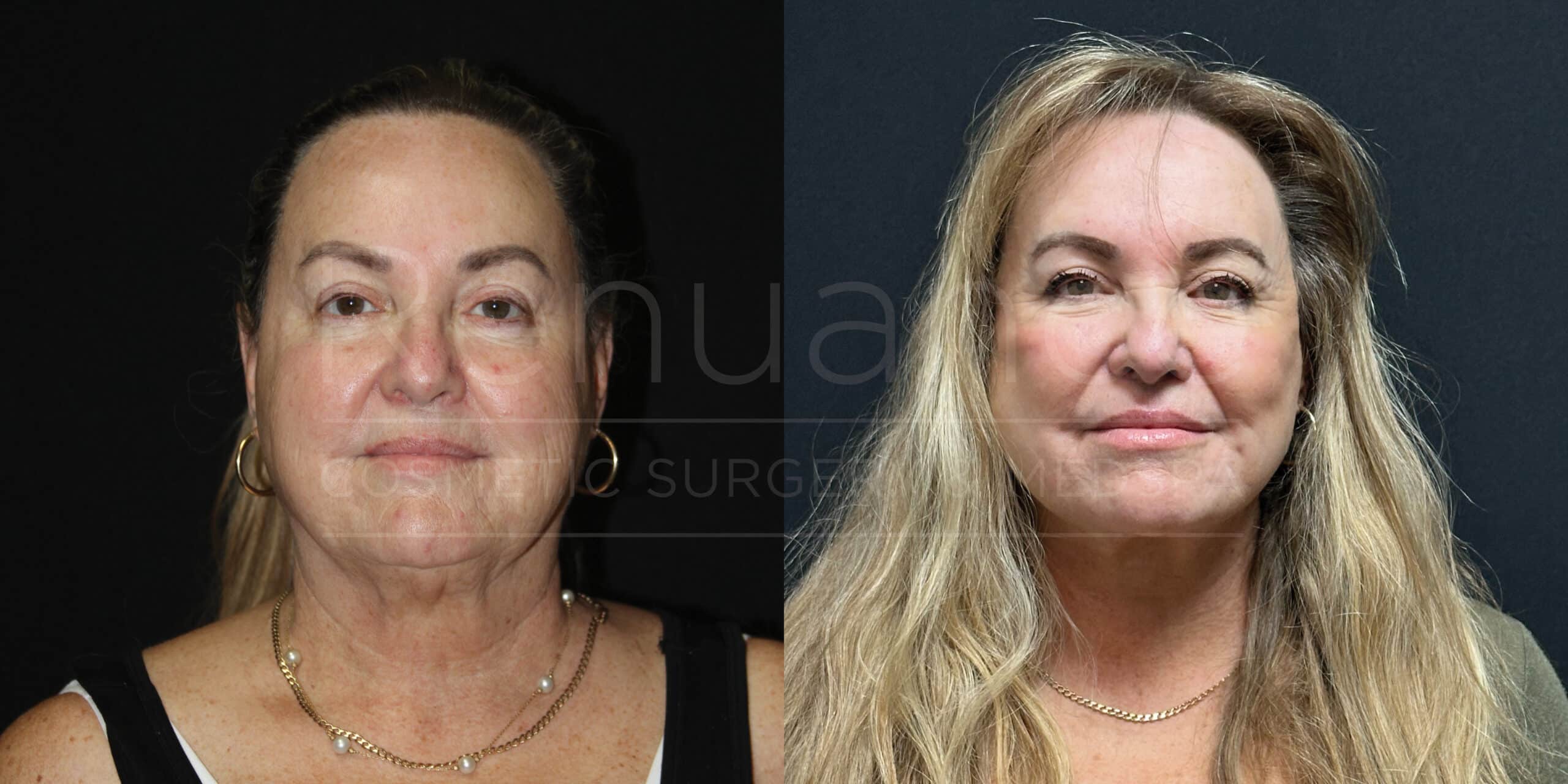A woman is shown in two side-by-side photos. The left image is a "before" photo where the woman is wearing her hair tied back and is dressed in a black garment with a white undershirt. In the right "after" photo, the woman has her hair down. Both images are set against a dark background. She is wearing gold jewelry in both images. The photos illustrate a change in her facial appearance, suggesting she may have undergone a cosmetic procedure.