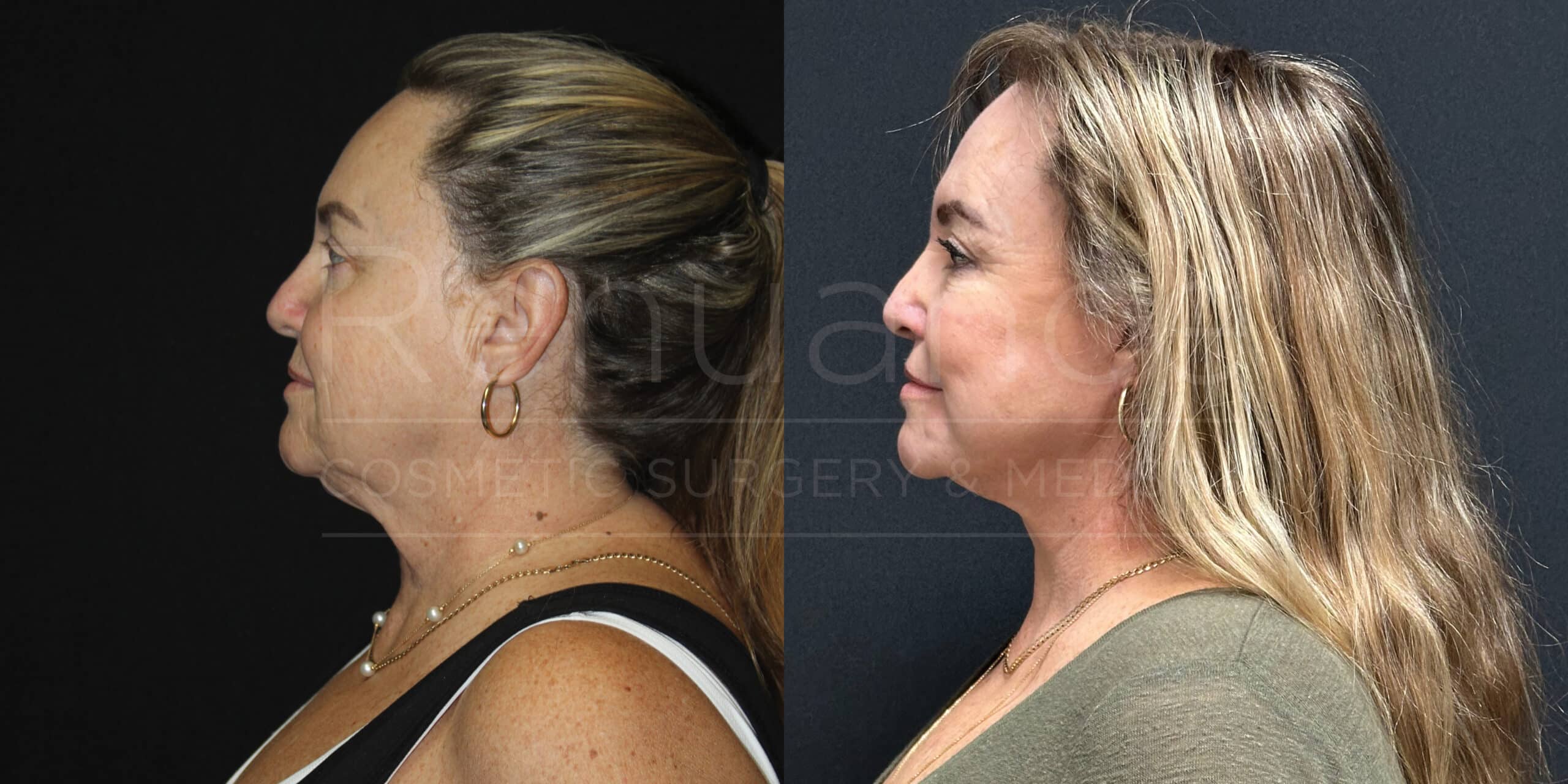Side-by-side comparison before and after images of a woman. The left image shows the woman with a heavier neck and jawline, while the right image shows noticeable improvements in neck and jawline contour after a cosmetic procedure. She has blonde hair pulled back in the "before" image and loose in the "after" image. Both images are taken against a dark background.