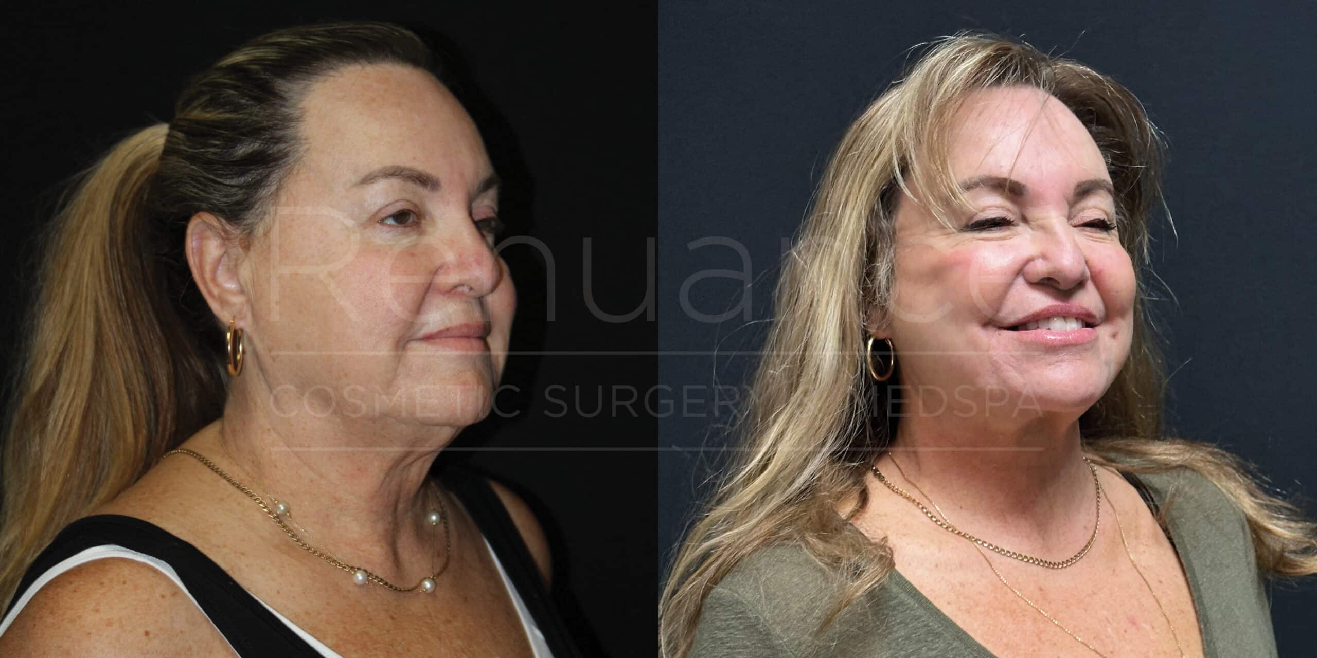 Side-by-side before and after images of a woman who has undergone a cosmetic procedure. In the left image (before), she is shown with fuller cheeks, a double chin, and looser skin on her neck area. In the right image (after), her appearance shows a more defined jawline, smoother neck area, and a tightened facial contour. She has blonde hair pulled back in the left image and styled down in the right image, with a noticeable improvement in her facial features.