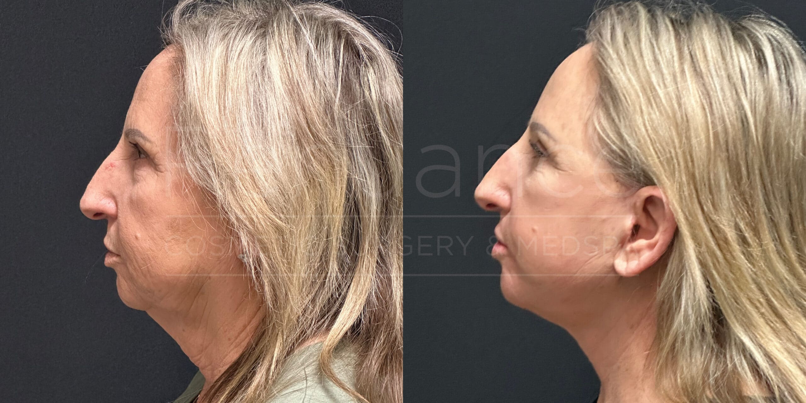 Side-by-side comparison image showing a woman's profile before and after receiving facial cosmetic surgery. The before image (left) shows noticeable sagging skin and a prominent chin. The after image (right) displays a more contoured jawline and smoother skin, highlighting the results of the surgical procedure. The woman has long, blonde hair in both images.