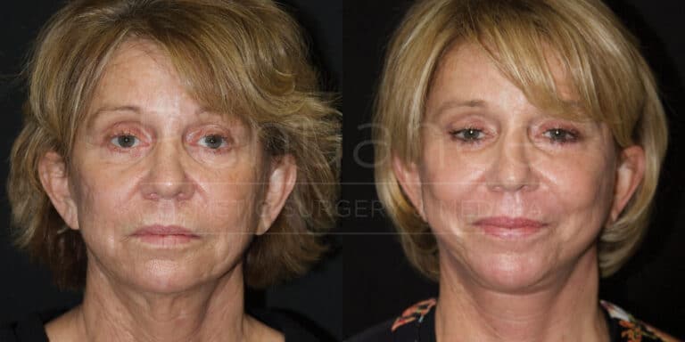 A side-by-side comparison image of a woman before and after undergoing a cosmetic surgery procedure. The left side shows the woman with visible signs of aging, such as wrinkles and sagging skin. The right side shows the woman after the procedure, with smoother skin, reduced wrinkles, and a more youthful appearance. The woman's hair is styled similarly in both images. Dark background is used for both images.