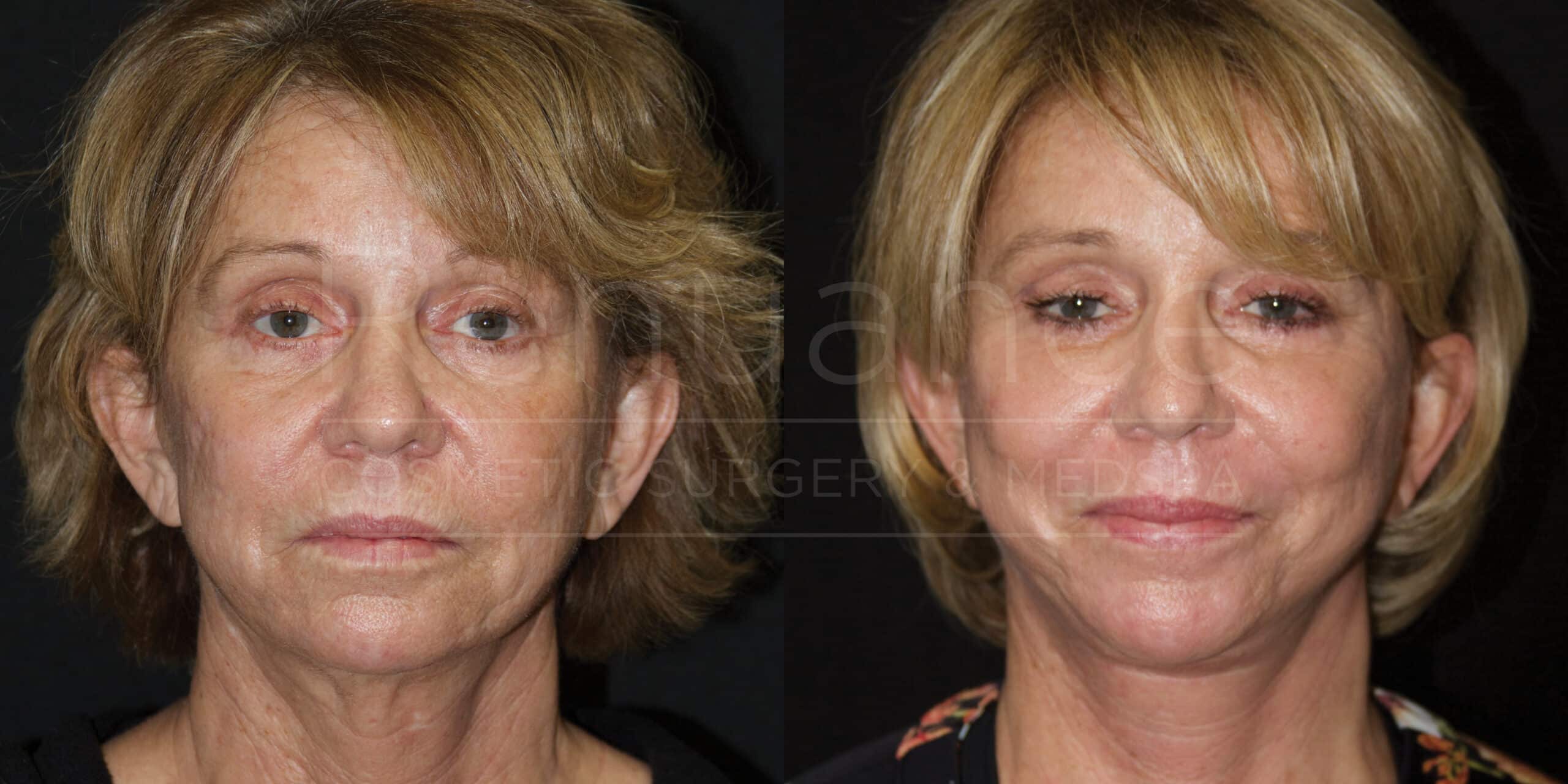 A side-by-side comparison image of a woman before and after undergoing a cosmetic surgery procedure. The left side shows the woman with visible signs of aging, such as wrinkles and sagging skin. The right side shows the woman after the procedure, with smoother skin, reduced wrinkles, and a more youthful appearance. The woman's hair is styled similarly in both images. Dark background is used for both images.