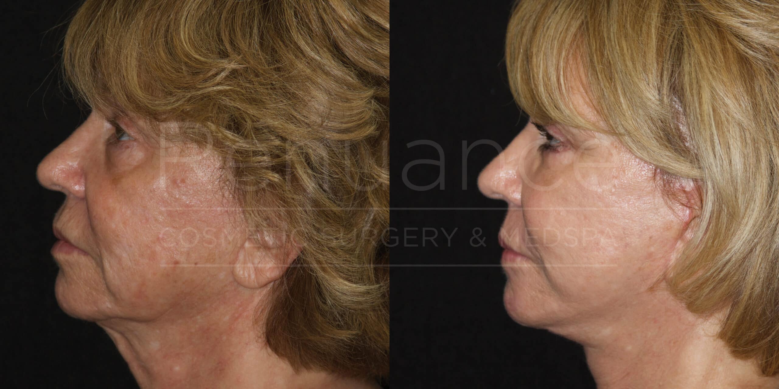 A before-and-after collage of a woman's profile showing the results of a cosmetic procedure. The left side of the image depicts the "before" state, where signs of aging such as sagging skin and wrinkles are visible. The right side of the image shows the "after" state, where the skin appears smoother, tighter, and more youthful. The woman has short, blonde hair in both images.