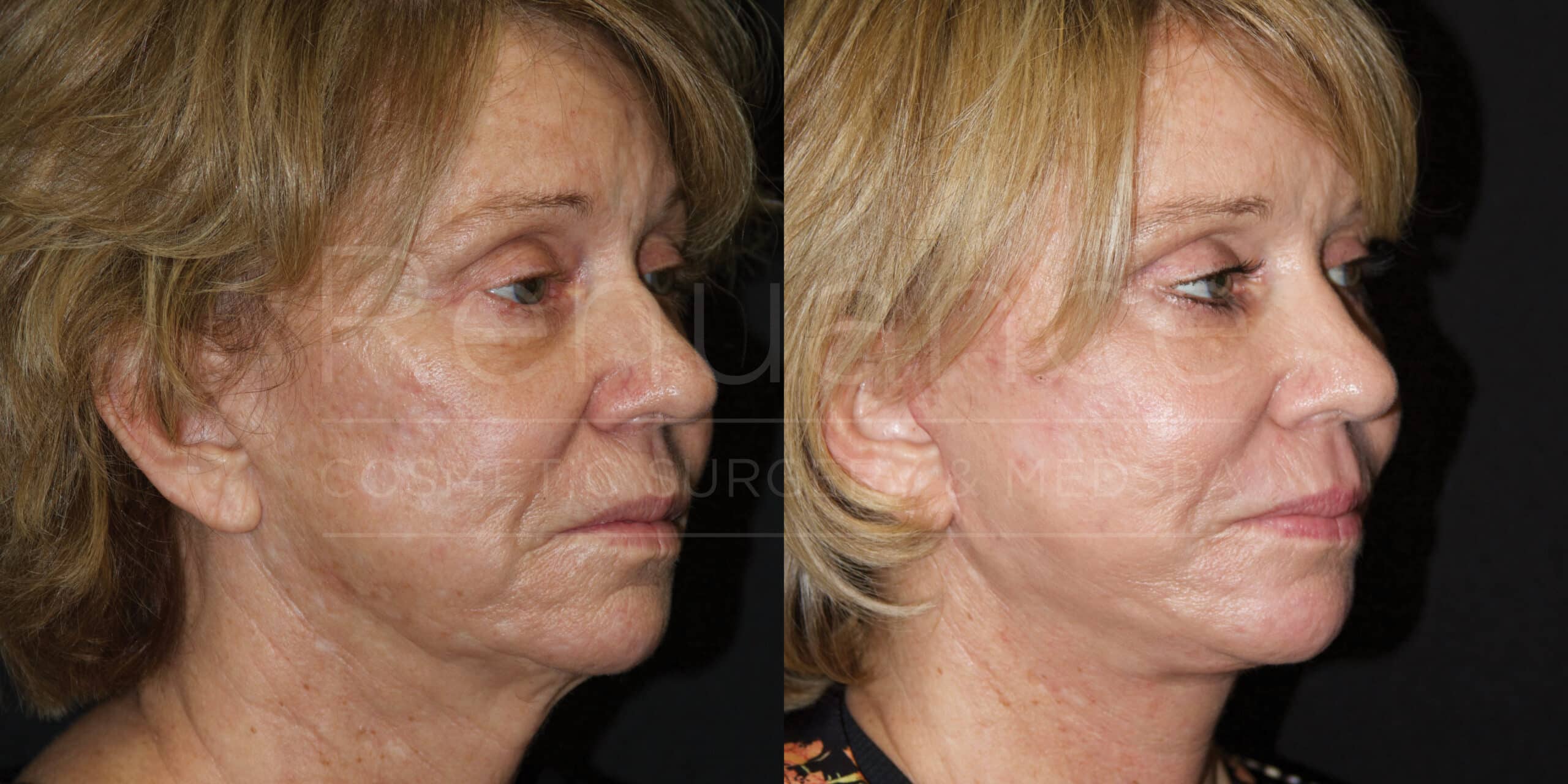 Side-by-side comparison of a woman before and after a cosmetic procedure. The left image shows the woman with visible wrinkles and sagging skin, while the right image shows the woman with smoother, tighter skin, indicating a more youthful appearance.