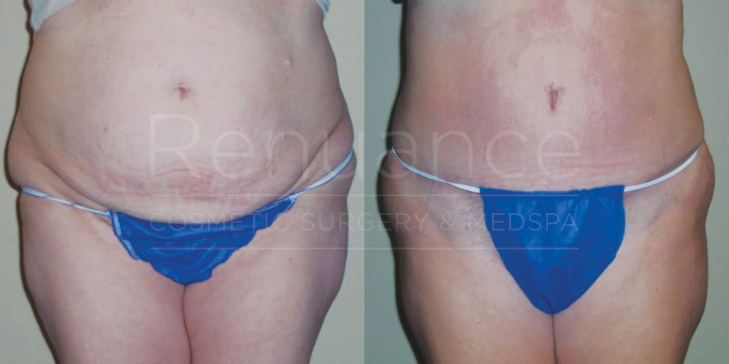 Before and after images of a person's abdominal area, showing the results of a cosmetic surgery procedure. In the left image, the person has more visible abdominal fat and loose skin. In the right image, the abdominal area appears flatter and more toned, with less visible fat and tighter skin. The person is wearing blue undergarments in both images.
