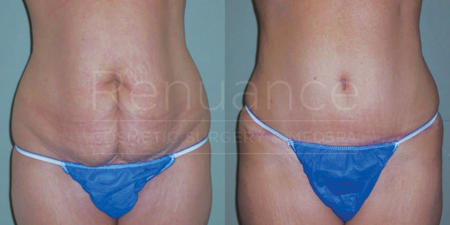 Side-by-side comparison of a person's abdomen before and after cosmetic surgery. The left image shows loose, sagging skin in the abdominal area, while the right image shows a firmer, smoother abdomen. The person is wearing a blue bikini bottom in both images.