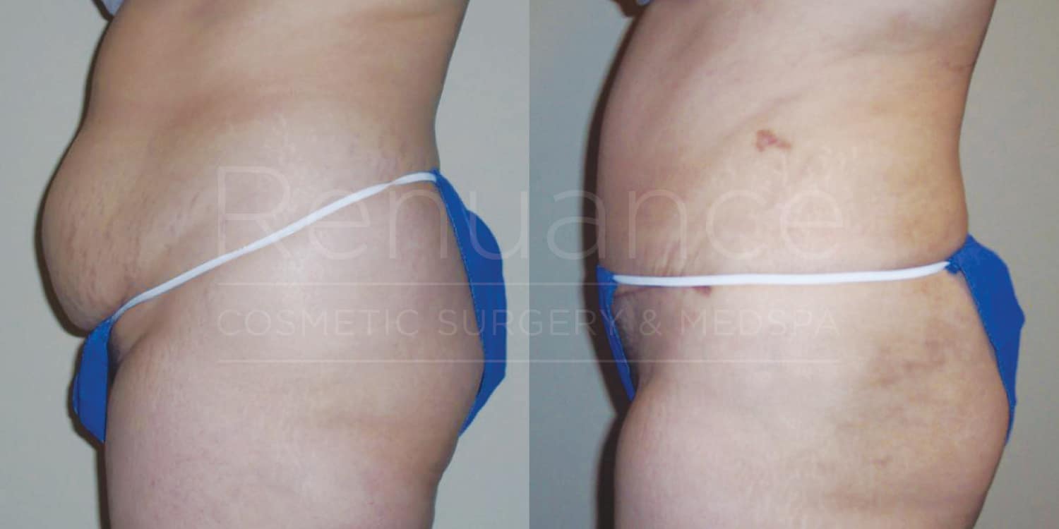 Two side-by-side images show a person's torso from a side view. The left image appears to depict the person before a cosmetic procedure, with visible excess abdominal fat and loose skin. The right image shows the same person after the procedure, with a notable reduction in abdominal fat and tighter skin. Both images have text overlay stating, "Renaissance COSMETIC SURGERY & MEDSPA." The person is wearing blue undergarments in both photos.