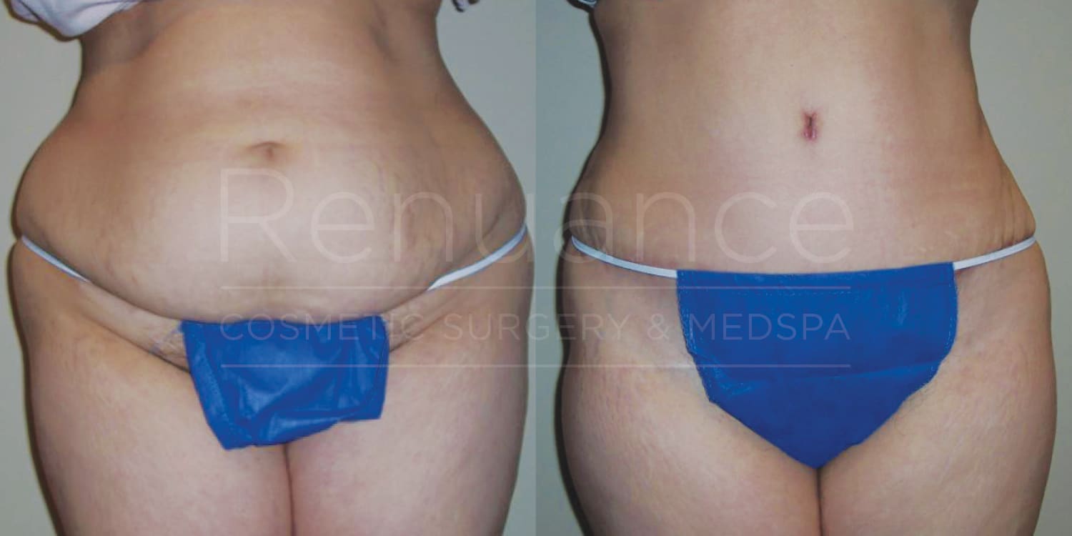 Alt text: "Before and after images of a person's midsection, showing the results of a cosmetic procedure. The left image shows a person with excess abdominal fat and loose skin, while the right image displays a more toned and firmer abdomen."