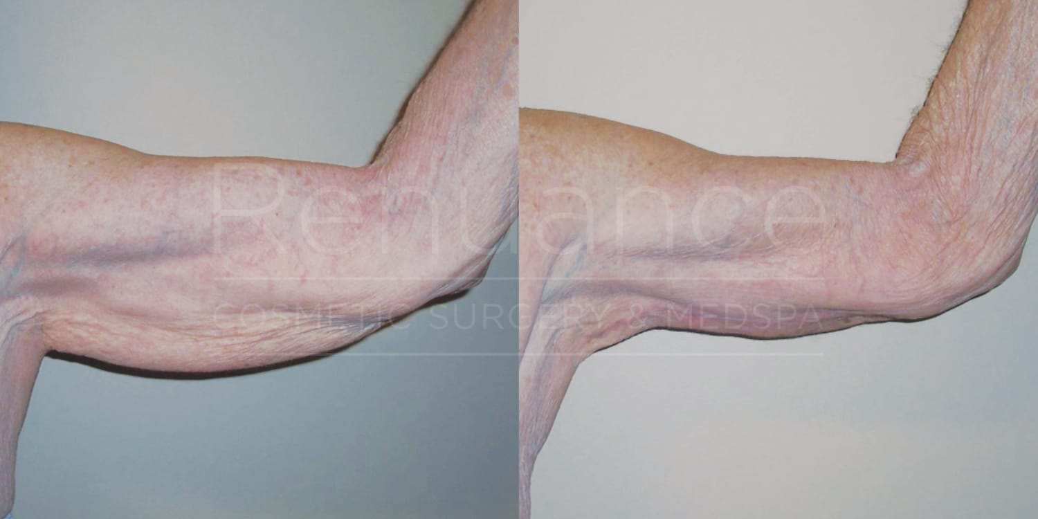Side-by-side images of a person's upper arm, showing a before and after comparison. The left image shows the arm with loose, sagging skin, while the right image shows the same arm after a procedure, with noticeably smoother and tighter skin. The text "Renaissance Cosmetic Surgery & Medspa" appears faintly over the images.