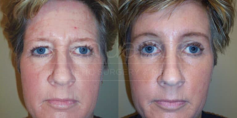 results of a brow lift