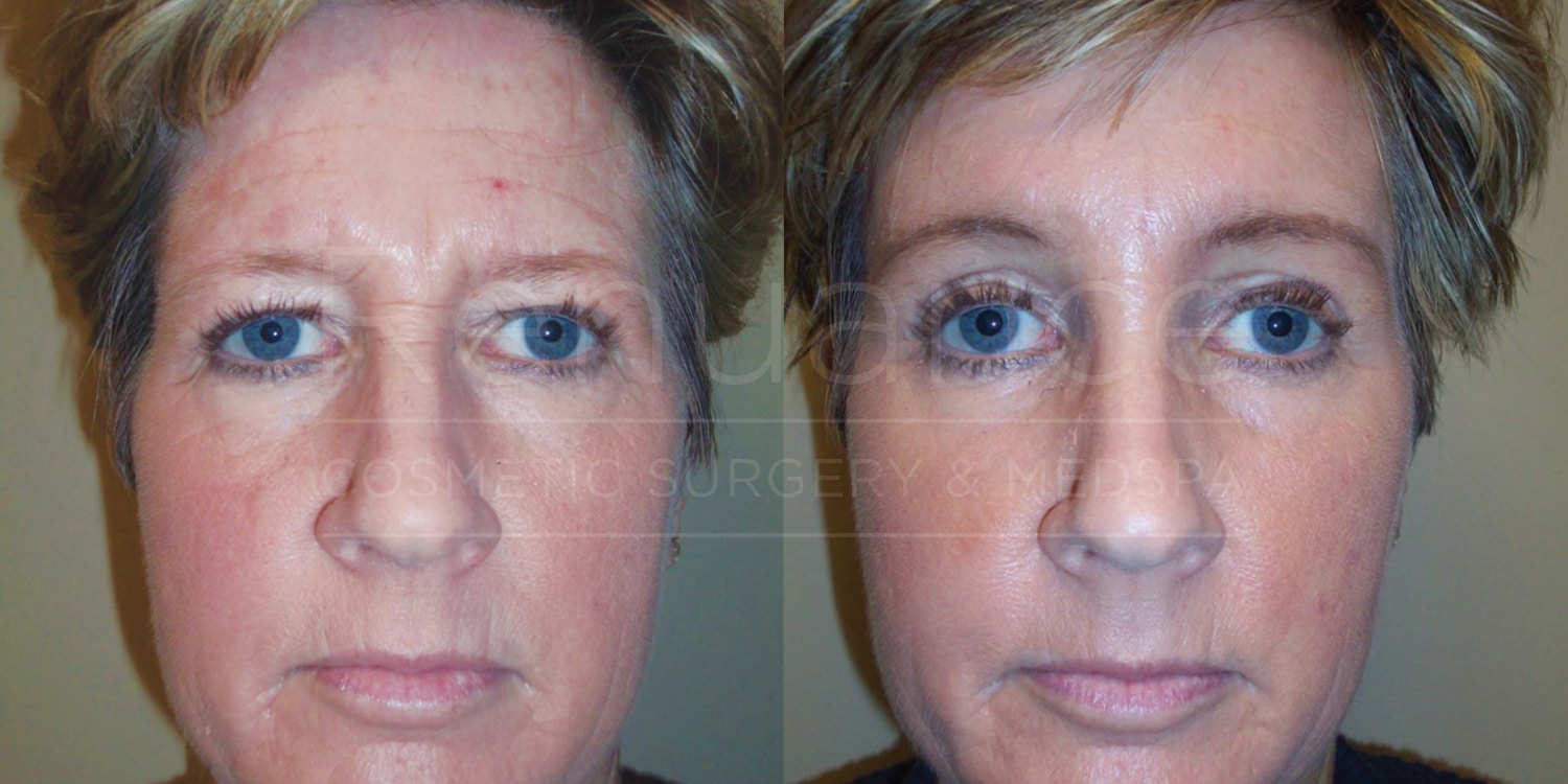 results of a brow lift