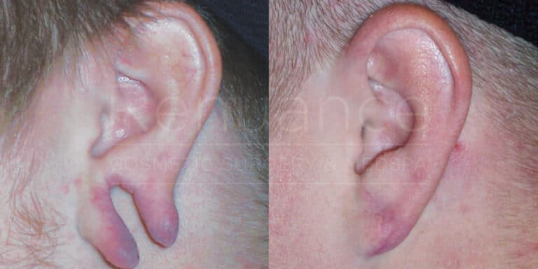 earlobe repair surgery results
