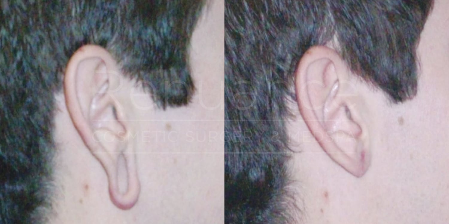 earlobe repair patient before and after the surgery