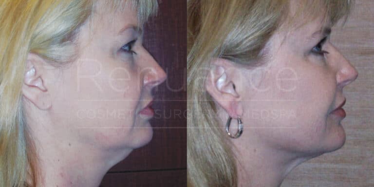 Side-by-side comparison images of a woman showing before and after results of a cosmetic surgery procedure. The image on the left shows her profile before the surgery, with a fuller jawline and neck. The image on the right shows her profile after the surgery, with a more defined jawline and a slimmer neck.