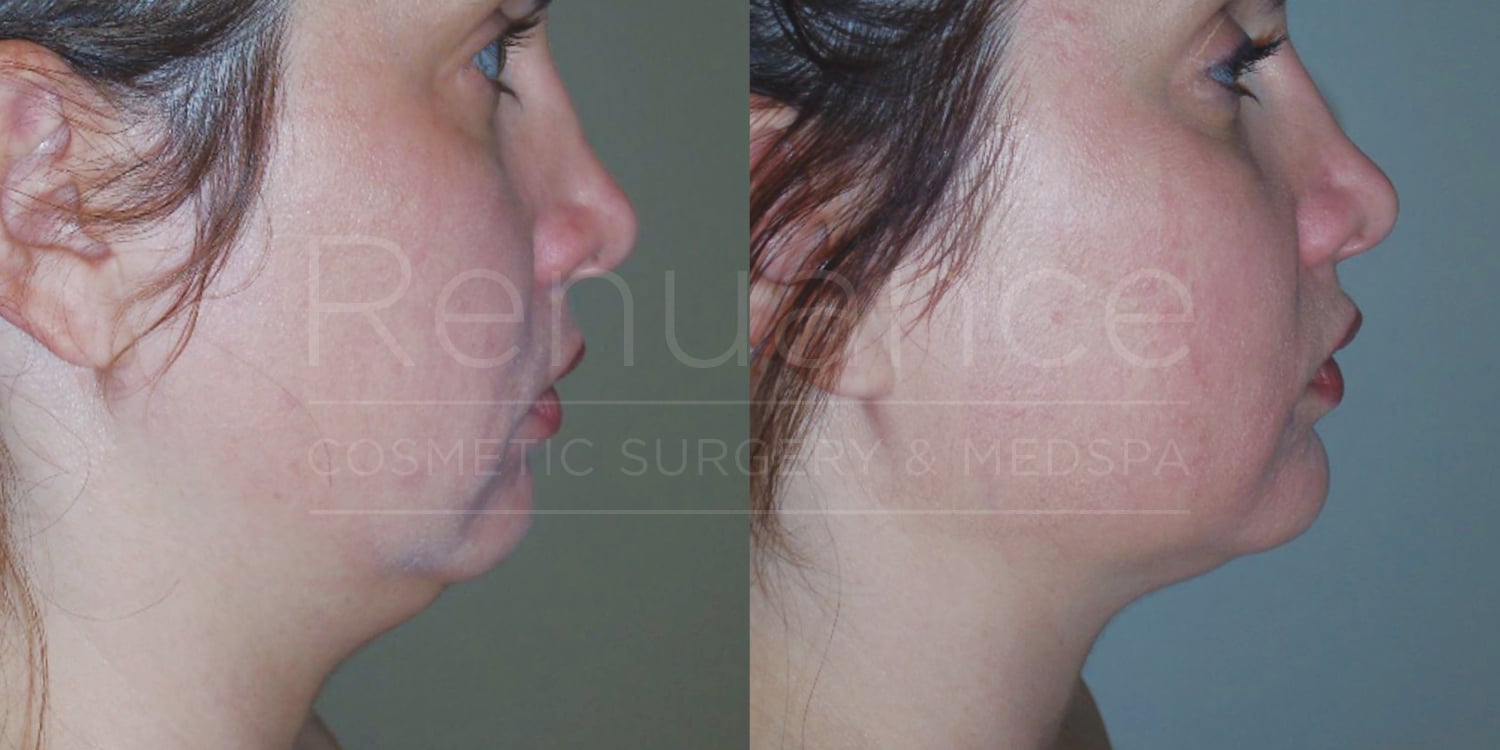 Side-by-side comparison of a woman's lower face and neck before and after cosmetic surgery. The left image shows loose skin and a less defined jawline, while the right image shows tighter skin and a more contoured jawline. The background is neutral, and the woman's hair is tied back in both images. Text overlay reads "Renewance Cosmetic Surgery & MedSpa."