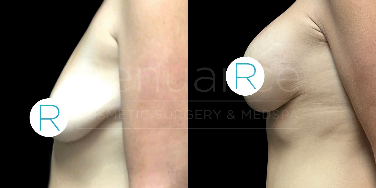 Side-by-side comparison of before and after images showing a person's upper arm and chest. The before image on the left shows sagging skin on the upper arm and side of the chest, while the after image on the right shows a firmer and more contoured appearance. A watermark reading "Renaissance Cosmetic Surgery & Medispa" is visible in the background.