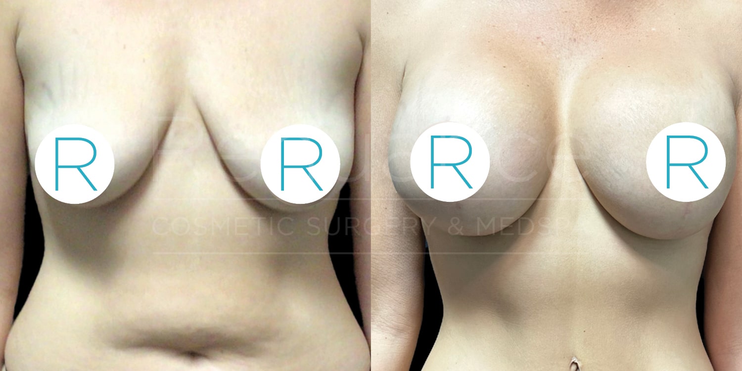 A side-by-side comparison of a female torso before and after breast augmentation surgery. The image on the left shows the torso with smaller, sagging breasts, while the image on the right shows the torso with larger, lifted breasts. Circular labels with the letter "R" cover the nipples in both images. The background is plain.