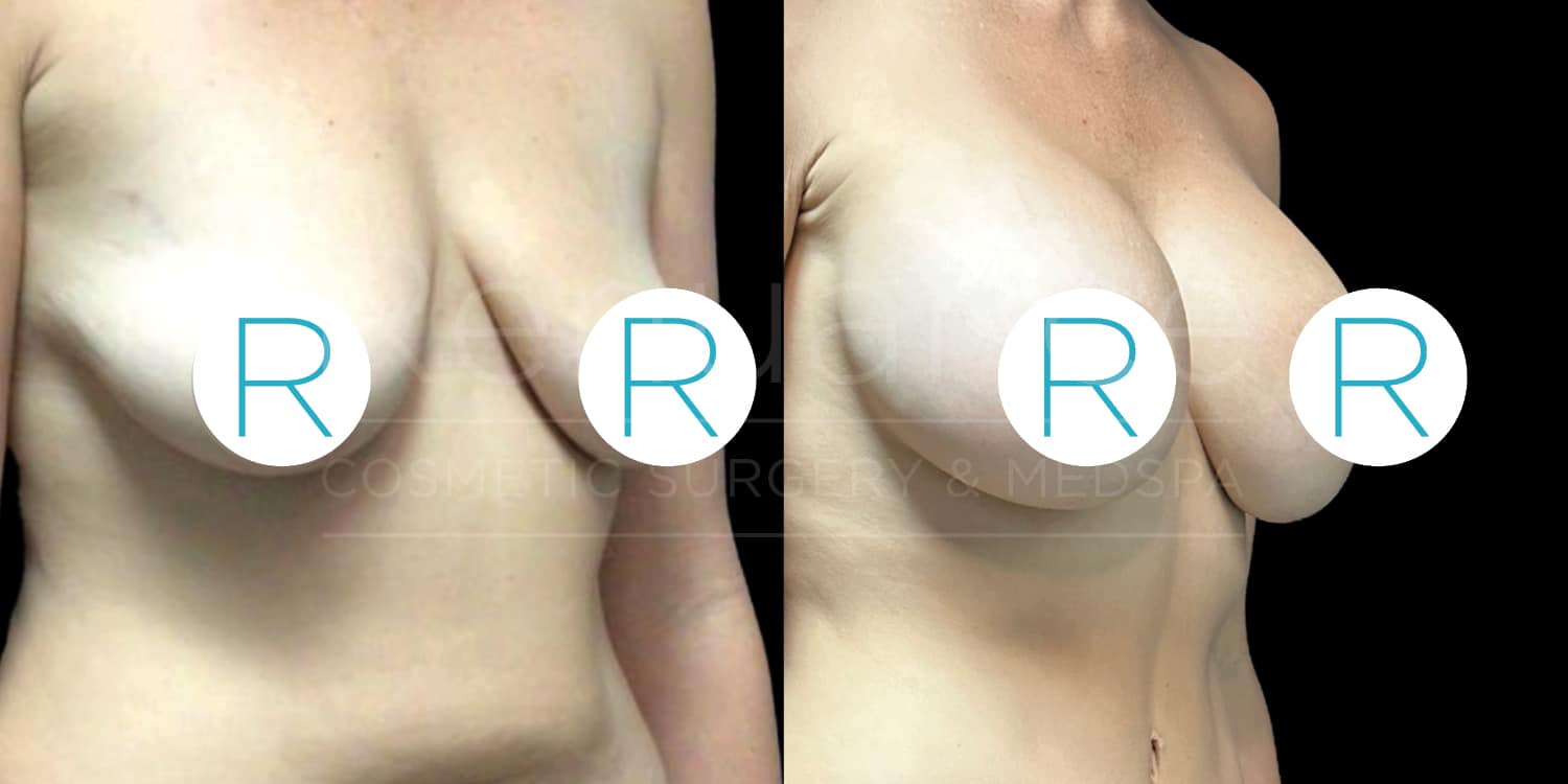 The image shows a side-by-side comparison of a person’s chest before and after a cosmetic breast surgery. On the left, the chest has a more natural, drooping appearance, while on the right, the chest appears fuller and more lifted, indicating the enhancement achieved from the surgery. The person's head and other parts of the body are not visible. The image is watermarked with the letters "R" overlapping both chests.