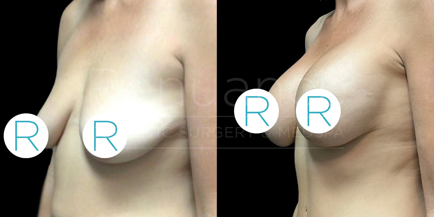 Before and after comparison showing the results of a breast augmentation procedure. The left side depicts a woman's upper torso with smaller, sagging breasts, while the right side shows the same woman with larger, lifted breasts post-surgery. Circular markers with the letter "R" are overlaid on both images for comparison reference. The background is black.