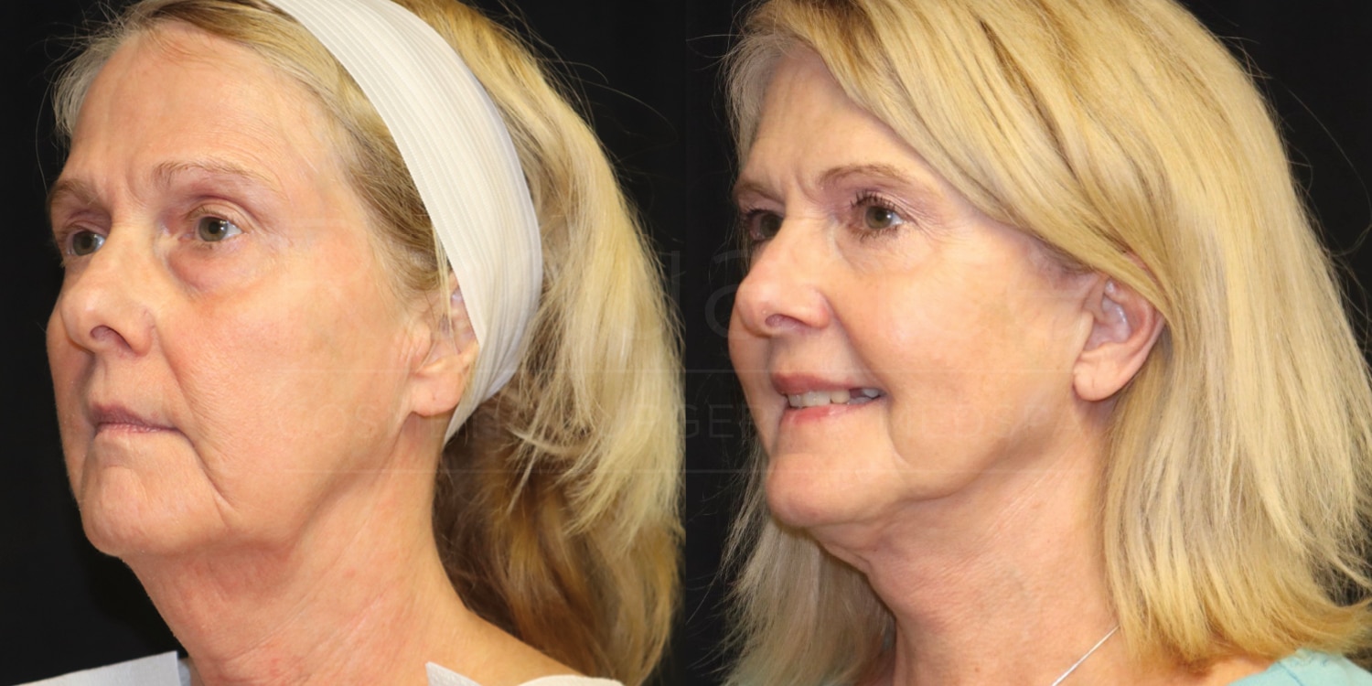 Side-by-side comparison of an older woman before and after a cosmetic procedure. The left image shows her with visible signs of aging such as sagging skin and wrinkles. In the right image, she appears more youthful with smoother skin, fewer wrinkles, and a lifted appearance. She is wearing a headband in the left image, while she is shown without the headband and smiling slightly in the right image.