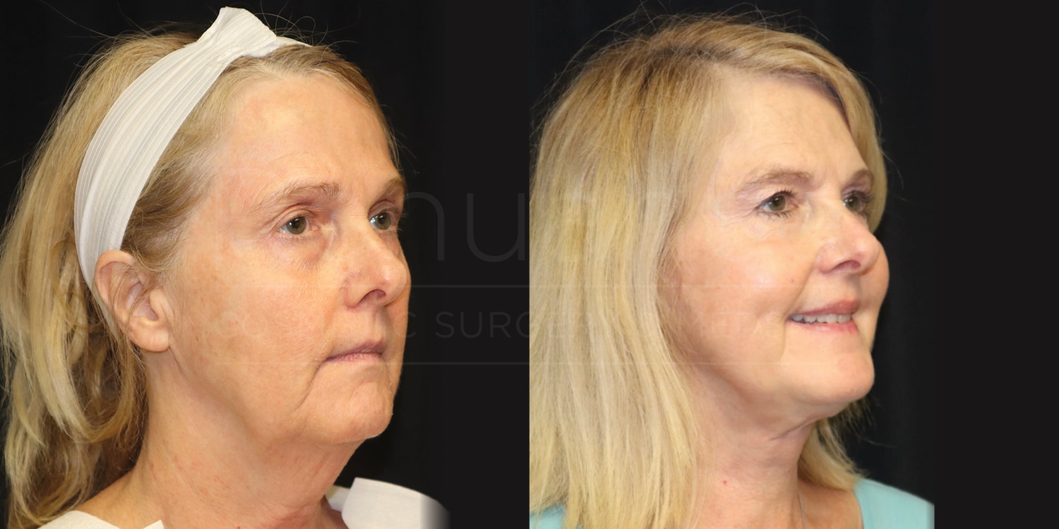 Two side-by-side images show a woman before and after a cosmetic procedure. In the "before" image on the left, the woman has a neutral expression and is wearing a white headband. In the "after" image on the right, the woman is smiling and her skin appears smoother and more youthful. She is no longer wearing the headband. The background in both images is dark.