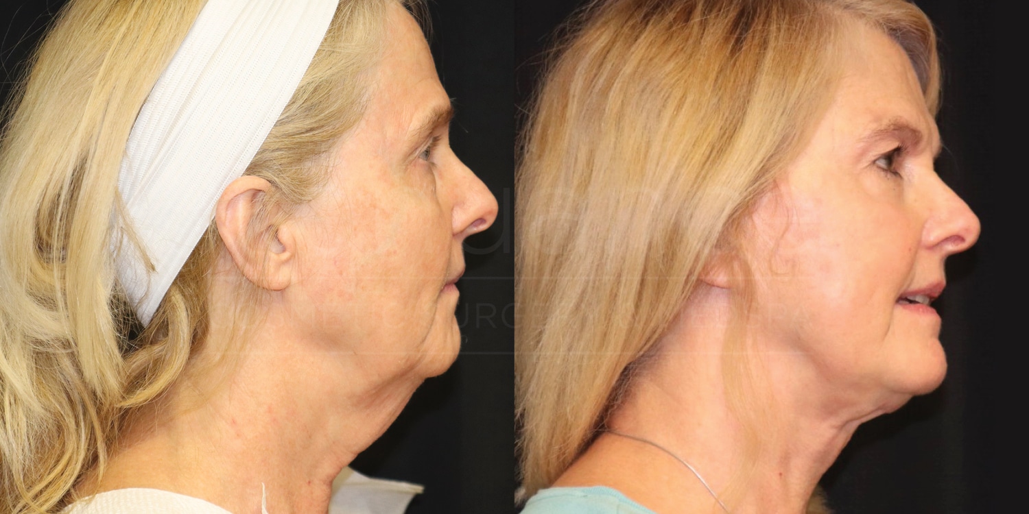 Side-by-side comparison images of a woman before and after a cosmetic procedure. The left image shows her profile before the procedure, with sagging skin around the neck and jawline. The right image shows her profile after the procedure, with tighter and smoother skin around the neck and jawline. She has blond hair and is wearing a light-colored top.