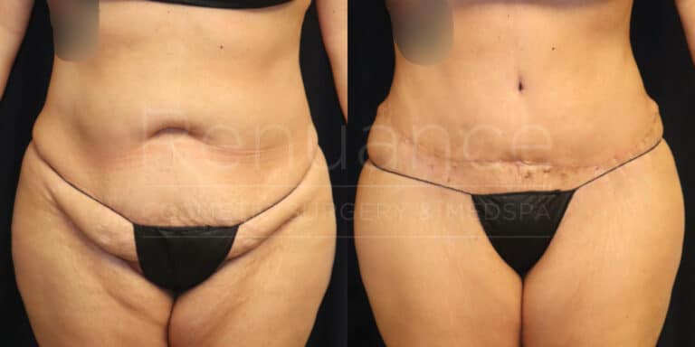 A before and after image of a woman who appears to have undergone a cosmetic surgery procedure. In the "before" image on the left, the woman has some extra skin and fat around her abdominal area. In the "after" image on the right, the woman's abdomen appears flatter and more toned, with a visible surgical scar above the bikini line. Both images show the woman wearing a black bikini bottom.