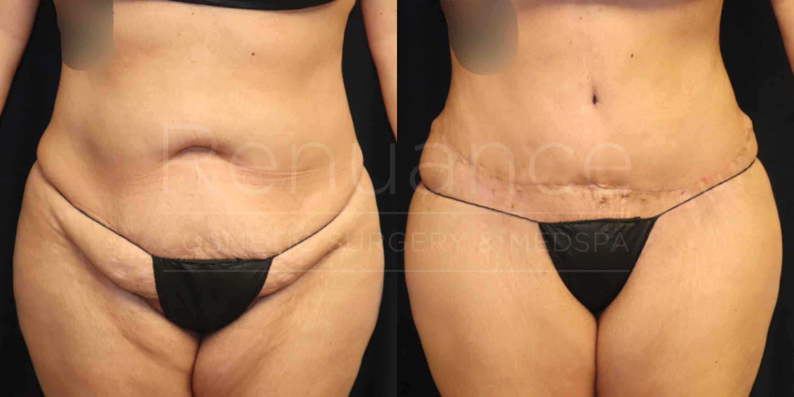 A before and after image of a woman who appears to have undergone a cosmetic surgery procedure. In the "before" image on the left, the woman has some extra skin and fat around her abdominal area. In the "after" image on the right, the woman's abdomen appears flatter and more toned, with a visible surgical scar above the bikini line. Both images show the woman wearing a black bikini bottom.