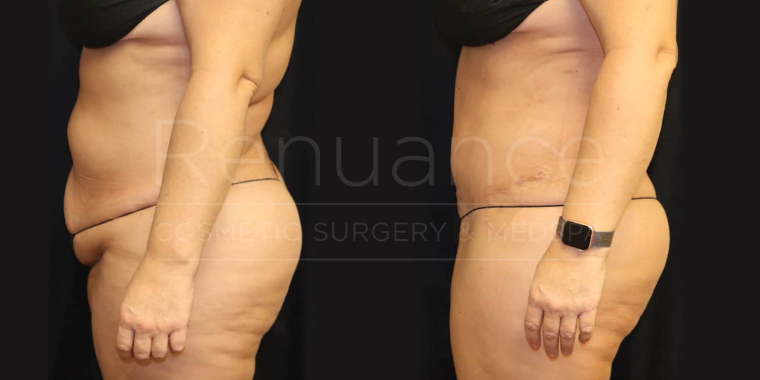 Side-by-side comparison of a woman's torso showing before and after results of a cosmetic procedure. The left side depicts the "before" image with excess abdominal fat, and the right side shows the "after" image with a visibly slimmer and more toned stomach. The woman is wearing black underwear in both images.