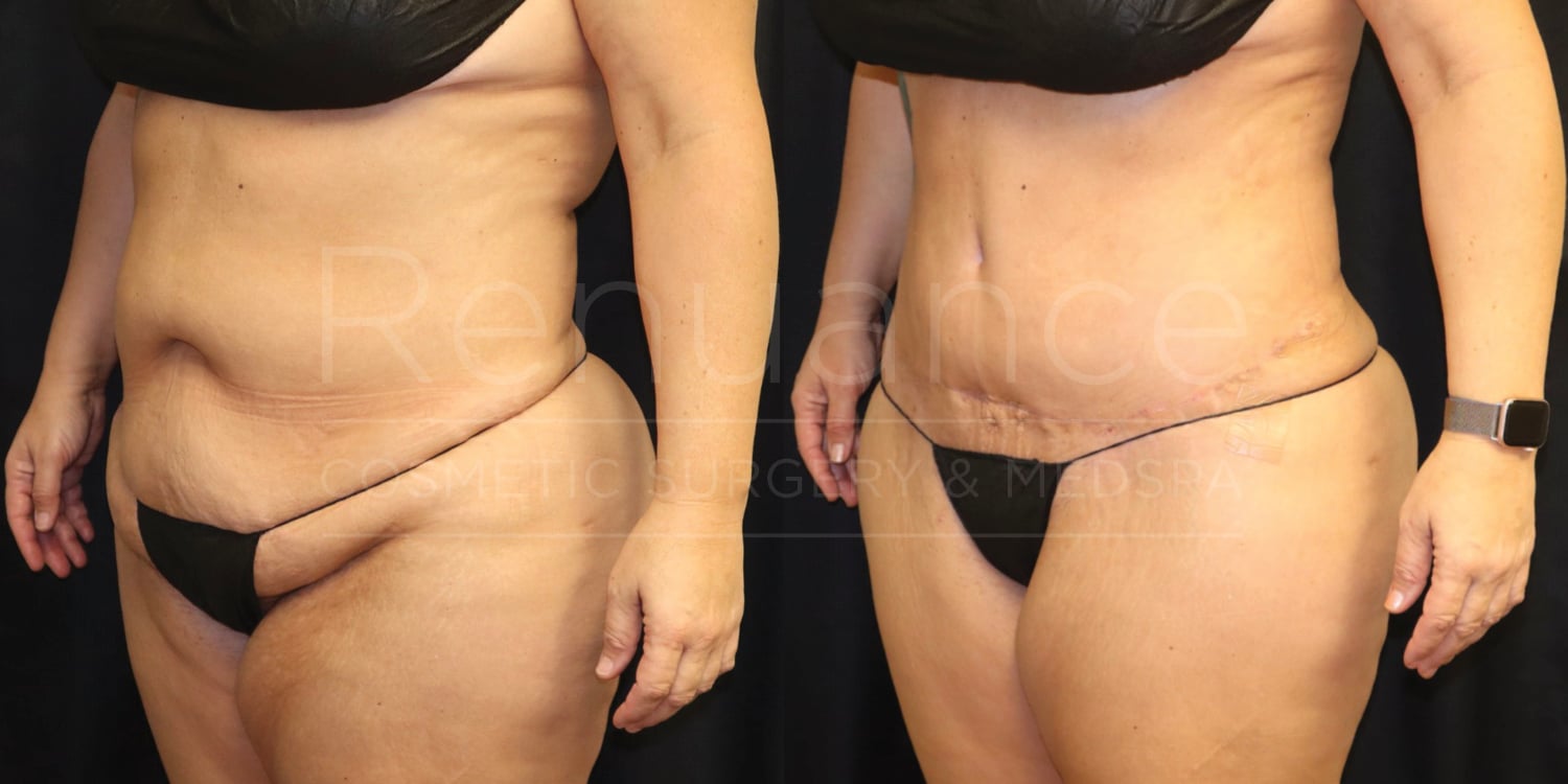 "Side-by-side comparison images of a woman's midsection before and after a cosmetic procedure. The first image on the left shows loose skin and excess fat. The second image on the right shows a more toned and tightened midsection after the procedure. The woman is wearing black underwear in both images."