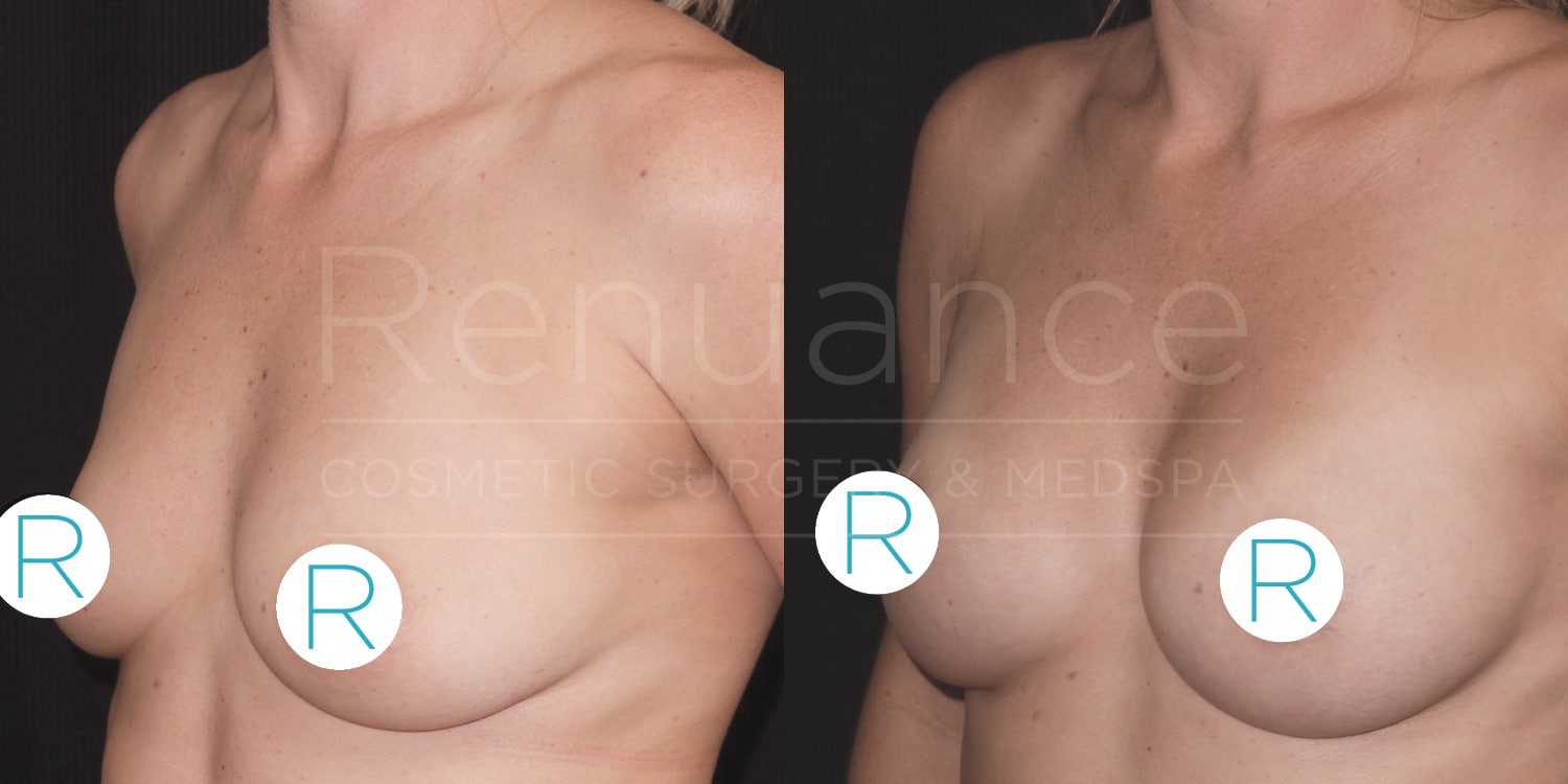 A before and after image of a person's torso from the side, showing the differences in breast appearance likely due to a cosmetic procedure. The image on the left shows the "before" state, and the image on the right shows the "after" state, with visible changes in size and shape of the breasts. Both images have letters "R" on them. The background has the text "Renuance Cosmetic Surgery & Medspa."