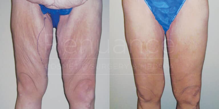 A before-and-after image showing the results of a cosmetic or medical procedure on the upper thighs. The left side displays loose skin and sagging on the thighs, while the right side shows tightened and smoother skin in the same area. The person is wearing blue undergarments in both images.
