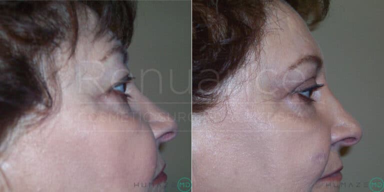 Side-by-side comparison of a person's profile before and after a cosmetic procedure. The left image shows the person's profile before the procedure, with visible signs of age. The right image shows the same profile after the procedure, with smoother and tighter skin. The differences indicate successful cosmetic improvements. The words "Renueance" and "Humaze MD" are faintly visible across both images.