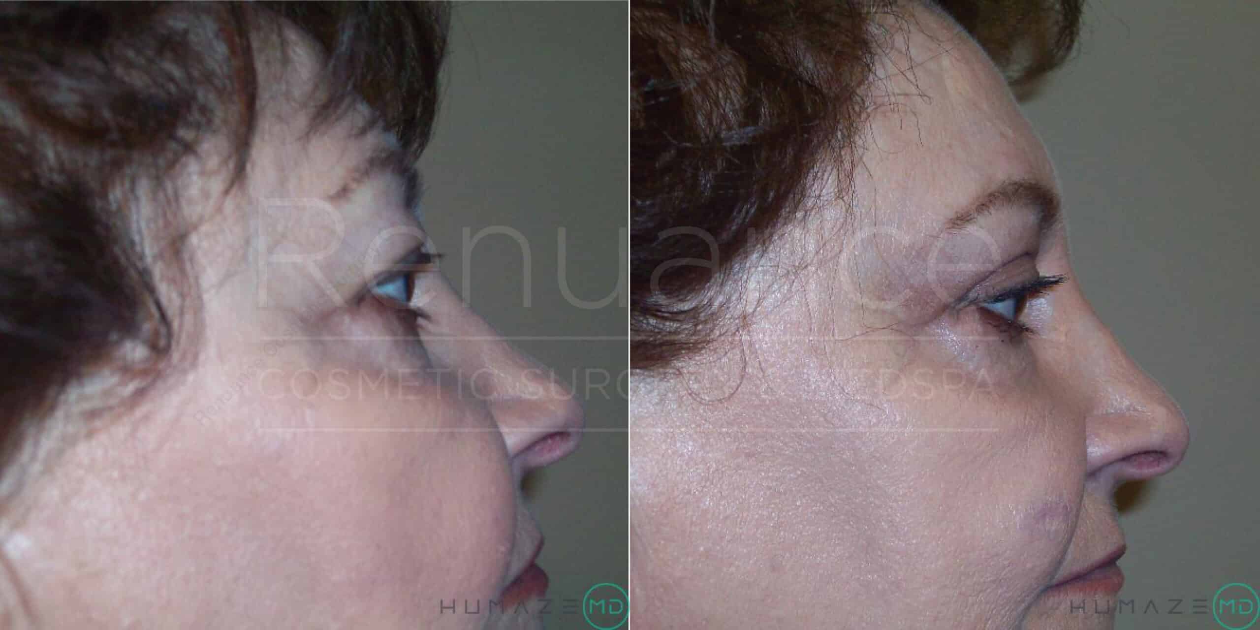 Side-by-side comparison of a person's profile before and after a cosmetic procedure. The left image shows the person's profile before the procedure, with visible signs of age. The right image shows the same profile after the procedure, with smoother and tighter skin. The differences indicate successful cosmetic improvements. The words "Renueance" and "Humaze MD" are faintly visible across both images.