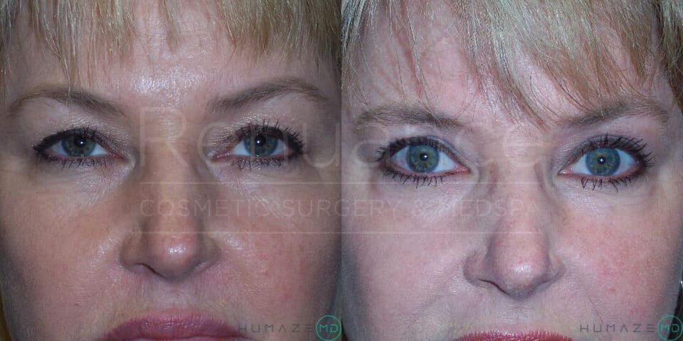Close-up images of a woman's face showing before and after results of a cosmetic procedure. The "before" image on the left shows the woman with more noticeable wrinkles and puffiness around the eyes and forehead. The "after" image on the right shows the woman with smoother skin, reduced puffiness around the eyes, and a more youthful appearance overall.
