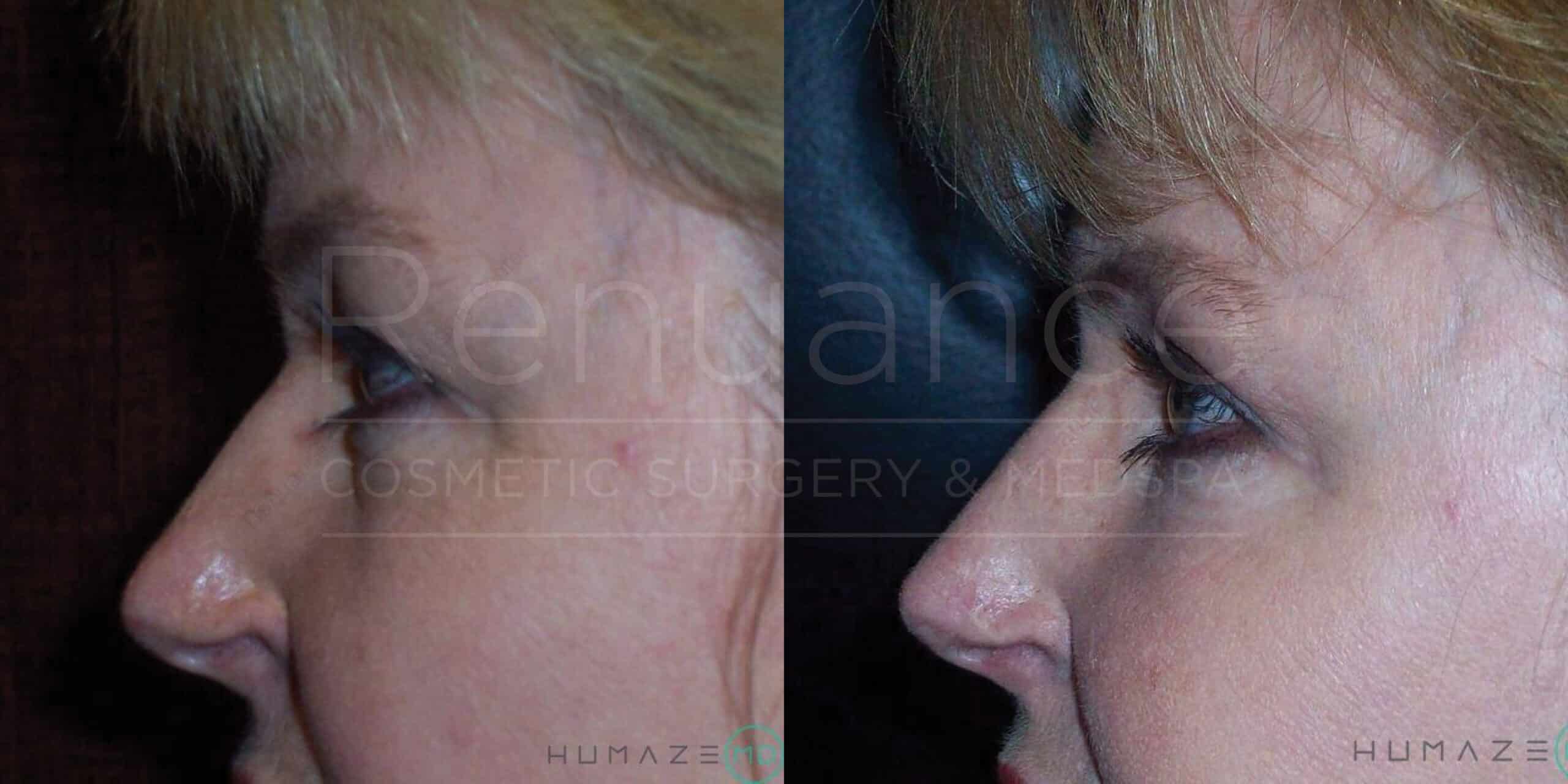 A side-by-side comparison of the same woman's face before and after a cosmetic procedure. The left image shows her face prior to the procedure, with visible wrinkles and imperfections. The right image shows her face after the procedure, with smoother skin and a more youthful appearance. Both images are overlaid with the words "Remanage Cosmetic Surgery & Medspa" and "HUMAZE."