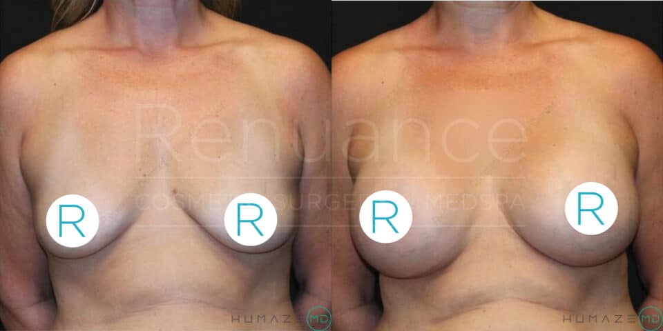 Side-by-side comparison of a topless woman showing before and after images of breast augmentation surgery. The image on the left depicts her natural breasts, while the image on the right shows her enhanced breasts post-surgery. Both images have blue circular stickers with the letter "R" covering the nipples to maintain privacy. The background is black, and the words "Renuance Cosmetic Surgery Med Spa" and "Humaze MD" are faintly visible in the center.
