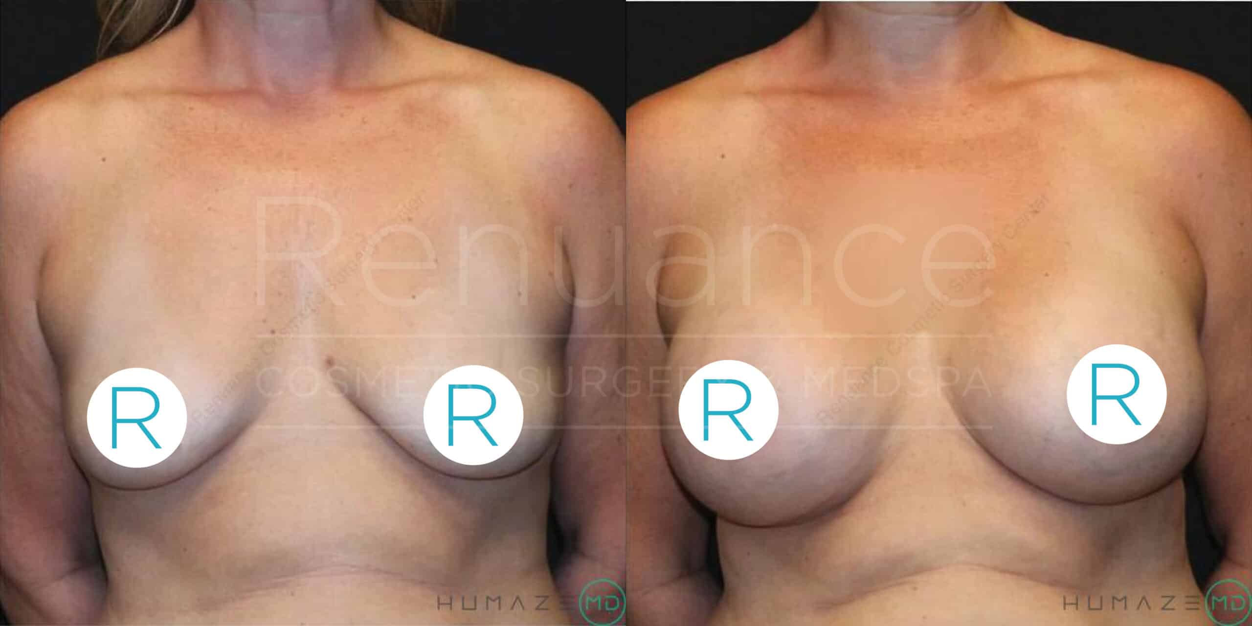 Side-by-side comparison of a topless woman showing before and after images of breast augmentation surgery. The image on the left depicts her natural breasts, while the image on the right shows her enhanced breasts post-surgery. Both images have blue circular stickers with the letter "R" covering the nipples to maintain privacy. The background is black, and the words "Renuance Cosmetic Surgery Med Spa" and "Humaze MD" are faintly visible in the center.