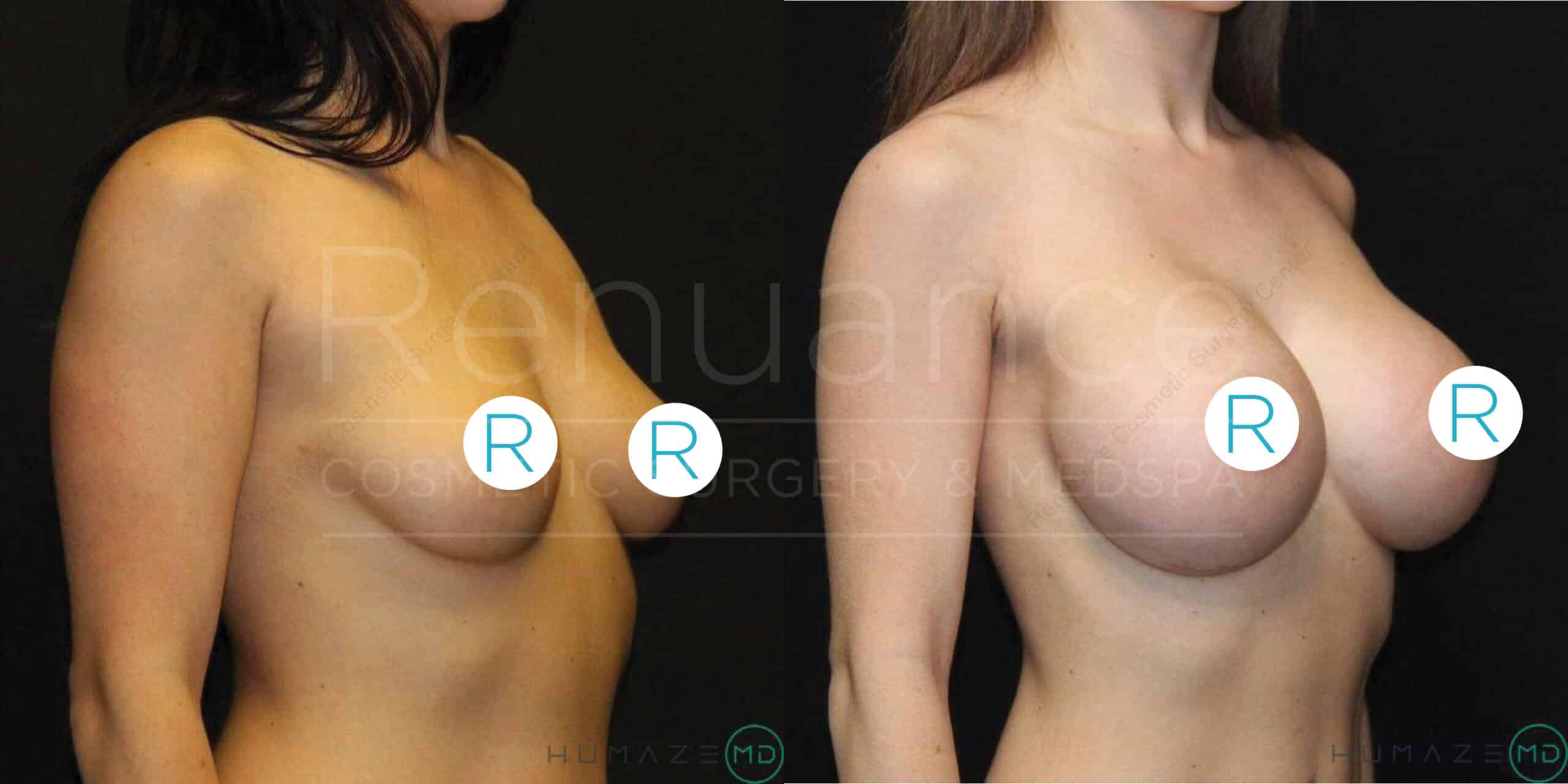 "Side by side comparison of a woman's torso before and after breast augmentation surgery. The left image shows smaller, natural breasts, and the right image shows larger, fuller breasts after enhancement. Both images have circular 'R' logos strategically placed on the breasts."