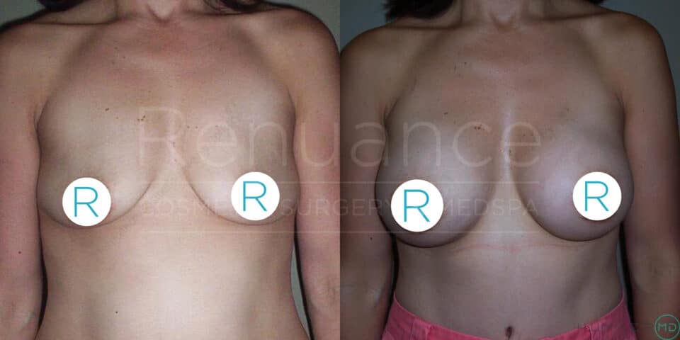 The image shows a side-by-side comparison of a woman’s chest before and after a breast augmentation or reconstruction procedure. The left side displays the "before" image, with visibly smaller and more ptotic breasts. The right side shows the "after" image, with larger and more symmetrical breasts. The nipples are blurred with circular labels marked with the letter "R". The woman is standing with no top in both images, and the background is dark, highlighting the body transformation.