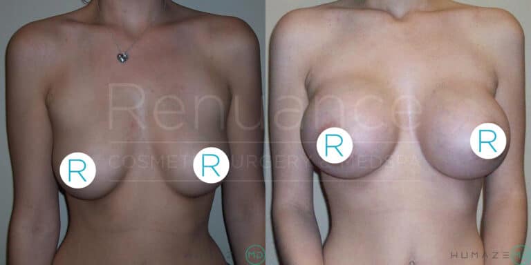 Before and after images showing a woman's upper torso, focusing on the results of a breast augmentation procedure. The left image shows the woman with smaller breasts, and the right image shows a noticeable increase in breast size post-surgery. Strategic blue circles with the letter "R" are used to cover the nipples for modesty. The text "Renuance Cosmetic Surgery & Med Spa" is faintly visible in the background.