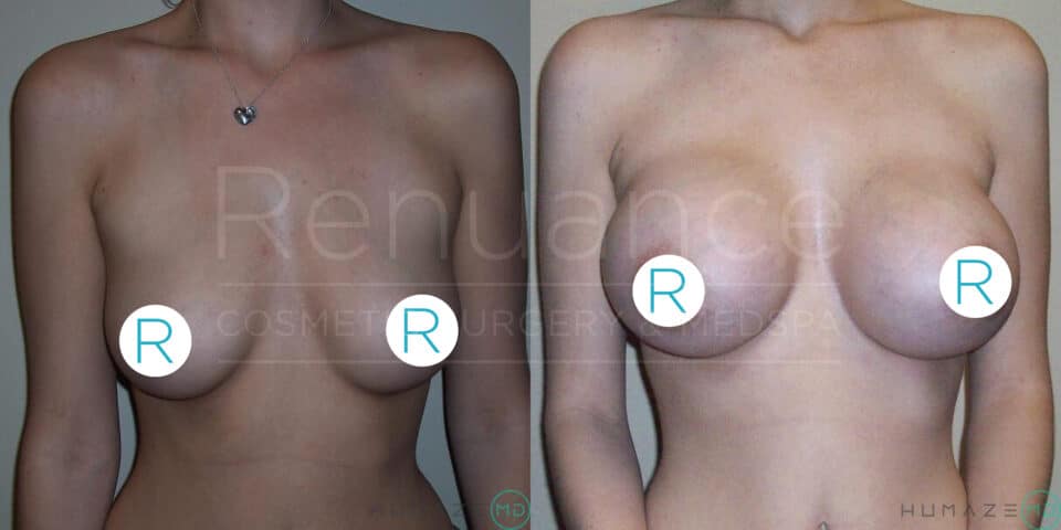 Before and after images showing a woman's upper torso, focusing on the results of a breast augmentation procedure. The left image shows the woman with smaller breasts, and the right image shows a noticeable increase in breast size post-surgery. Strategic blue circles with the letter "R" are used to cover the nipples for modesty. The text "Renuance Cosmetic Surgery & Med Spa" is faintly visible in the background.