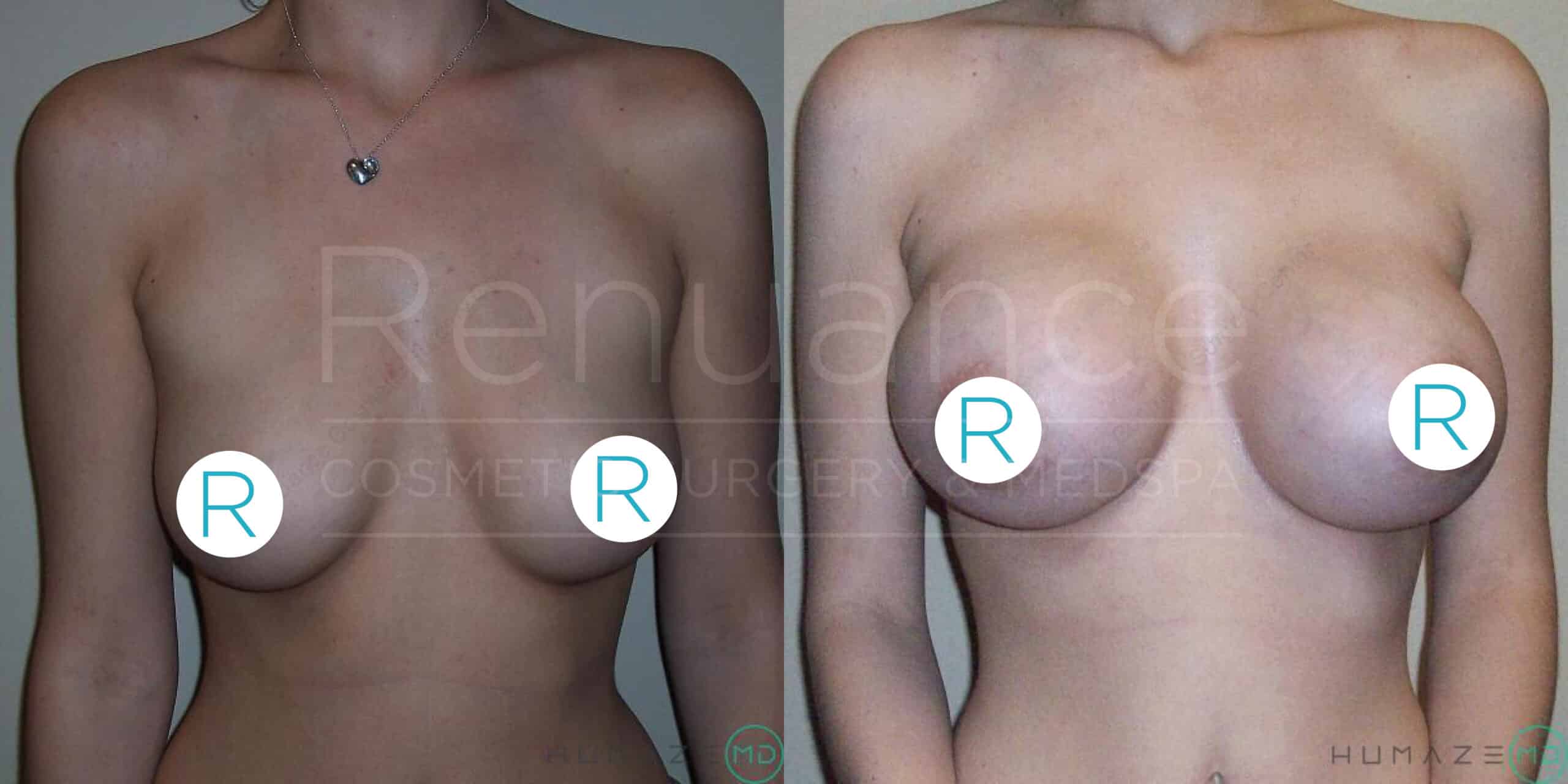 Before and after images showing a woman's upper torso, focusing on the results of a breast augmentation procedure. The left image shows the woman with smaller breasts, and the right image shows a noticeable increase in breast size post-surgery. Strategic blue circles with the letter "R" are used to cover the nipples for modesty. The text "Renuance Cosmetic Surgery & Med Spa" is faintly visible in the background.