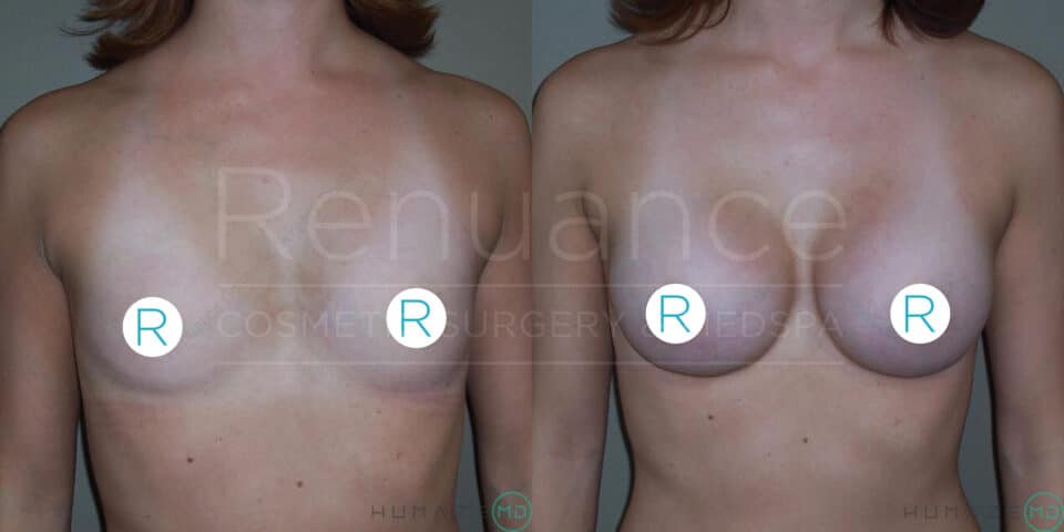 A side-by-side comparison of a woman's upper torso before and after a cosmetic breast surgery procedure. The left image shows the woman's chest prior to the surgery, while the right image displays the enhanced results post-surgery.