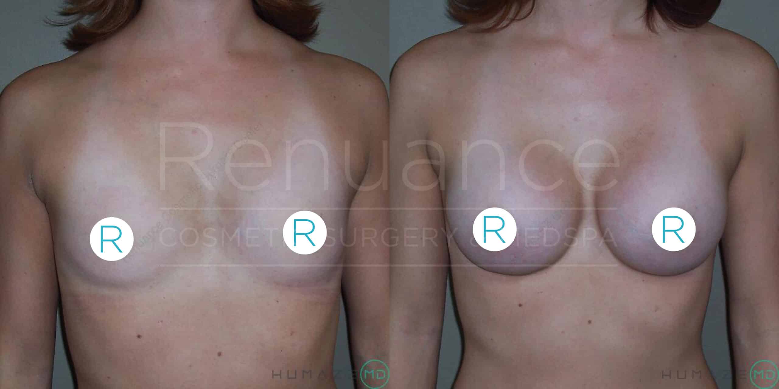 A side-by-side comparison of a woman's upper torso before and after a cosmetic breast surgery procedure. The left image shows the woman's chest prior to the surgery, while the right image displays the enhanced results post-surgery.