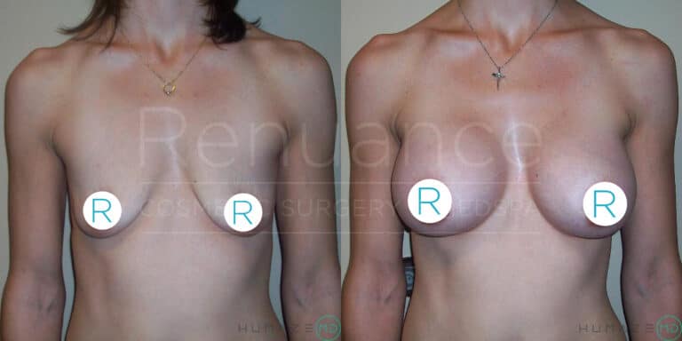 Before and after photo of a person's torso showing the results of breast augmentation. The left image shows a flat chest, while the right image shows a fuller chest after surgery. The nipples are covered with circular markers labeled "R."